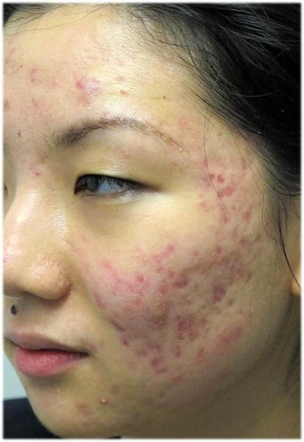 Acne Therapy