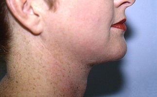 Neck Liposuction
