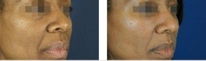 Fillers To Cheeks