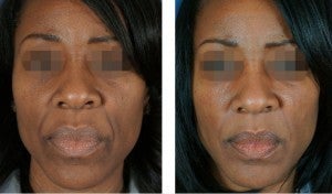 Fillers To Cheeks