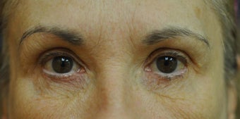 Fractionated CO2 Laser Treatment for Facial Wrinkles and Aging