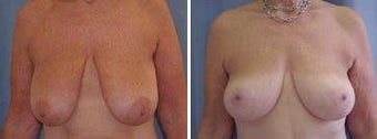 61 years old / breast reduction