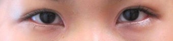 Bilateral Asian Eyelid w Z-plasty Surgery