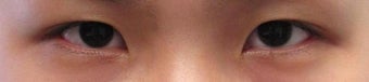 Bilateral Asian Eyelid w Z-plasty Surgery