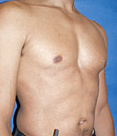 Pec Implants