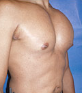 Pec Implants