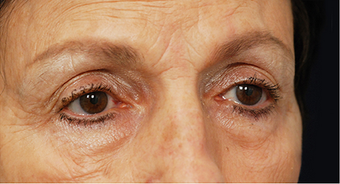 Eye Bag Surgery