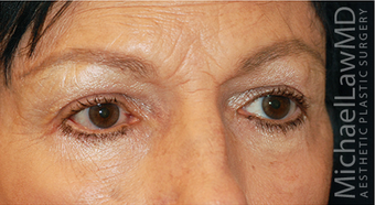 Eye Bag Surgery