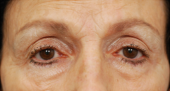 Eye Bag Surgery