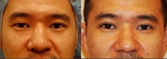 Male Asian Eyelid Surgery