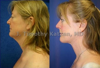Neck liposuction