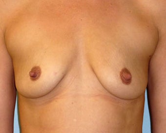 Breast Augmentation Restores Volume