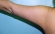 42 year old female patient 
