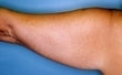 42 year old female patient 