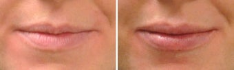 Lip Augmentation