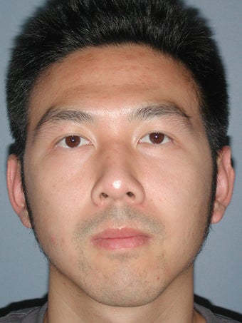 Otoplasty/Ear Surgery