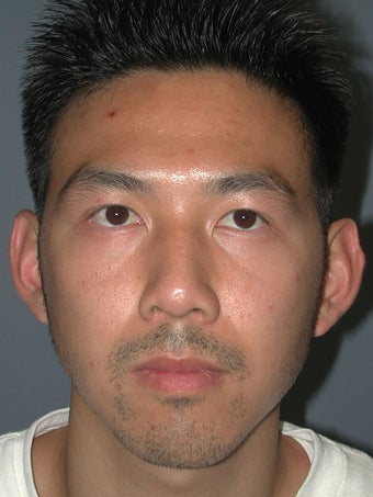 Otoplasty/Ear Surgery