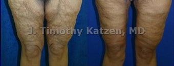 Thigh Lift after massive weight loss