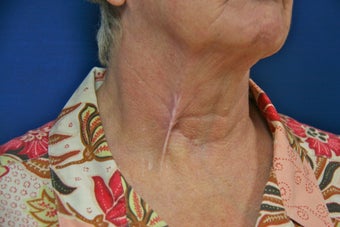 Tethered Neck Scar Revision