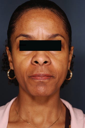 Fillers and Botox
