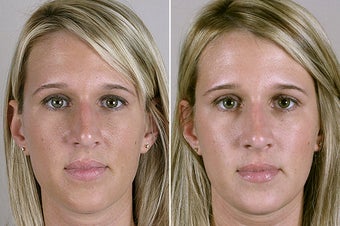 Female Rhinoplasty