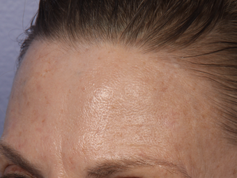 Limelight IPL to Forehead