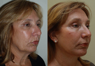 Neck Lift