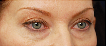 Eye Bag Surgery