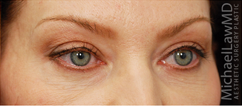 Eye Bag Surgery