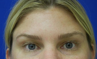 Forehead Lines