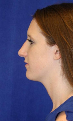 Rhinoplasty 