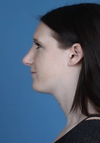 Rhinoplasty 