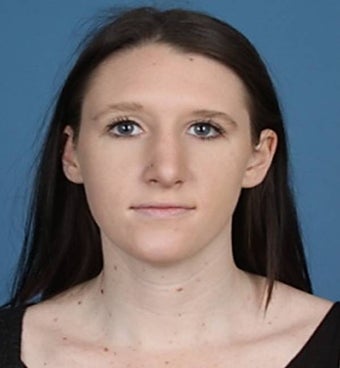 Rhinoplasty 