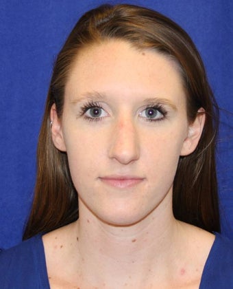 Rhinoplasty 