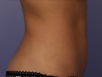 Zeltiq CoolSculpting- Lower Abdomen