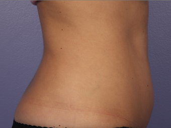 Zeltiq CoolSculpting- Lower Abdomen
