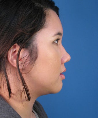 Asian Rhinoplasty Surgery Ethnic Rhinoplasty Example