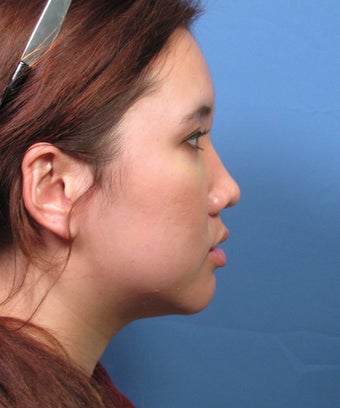 Asian Rhinoplasty Surgery Ethnic Rhinoplasty Example