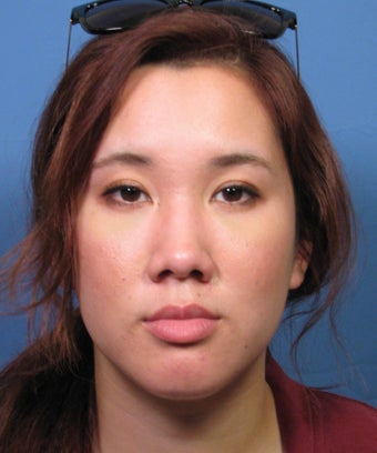 Asian Rhinoplasty Surgery Ethnic Rhinoplasty Example