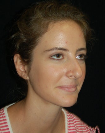 Revision Rhinoplasty