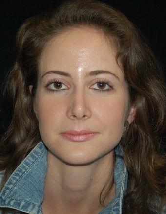 Revision Rhinoplasty