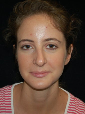 Revision Rhinoplasty
