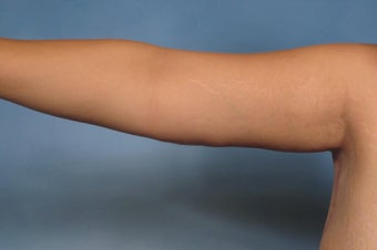 Arm Lift 