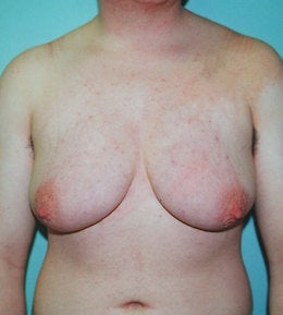 41-Year-Old Male Breast Reduction