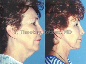 Neck lift and face lift after massive weight loss
