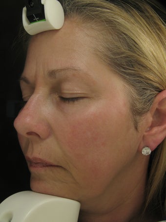 Fraxel Dual Laser for Melasma, Pigmentation, and Rosacea