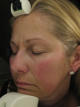 Fraxel Dual Laser for Melasma, Pigmentation, and Rosacea