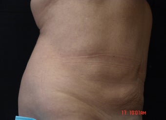Coolsculpting