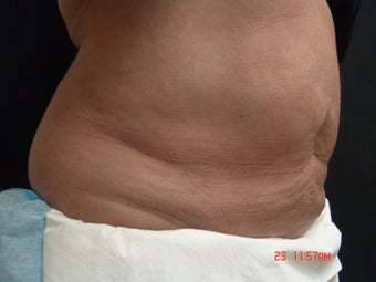 Coolsculpting
