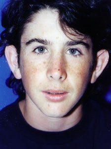 Otoplasty Male - Boy treated by Ear Surgery
